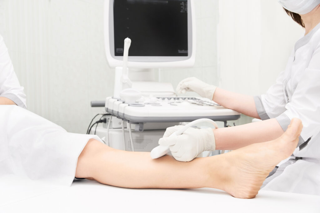 Ultrasound Guided Sclerotherapy Los Angeles CA