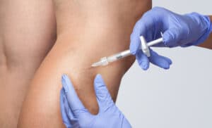Patient getting foam sclerotherapy treatment in leg in Los Angeles, CA