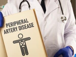 Doctor holding a notepad that says Peripheral artery disease PAD in Los Angeles, CA