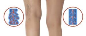 Close up varicose veins with diagram of damaged vs healthy veins in Los Angeles, CA
