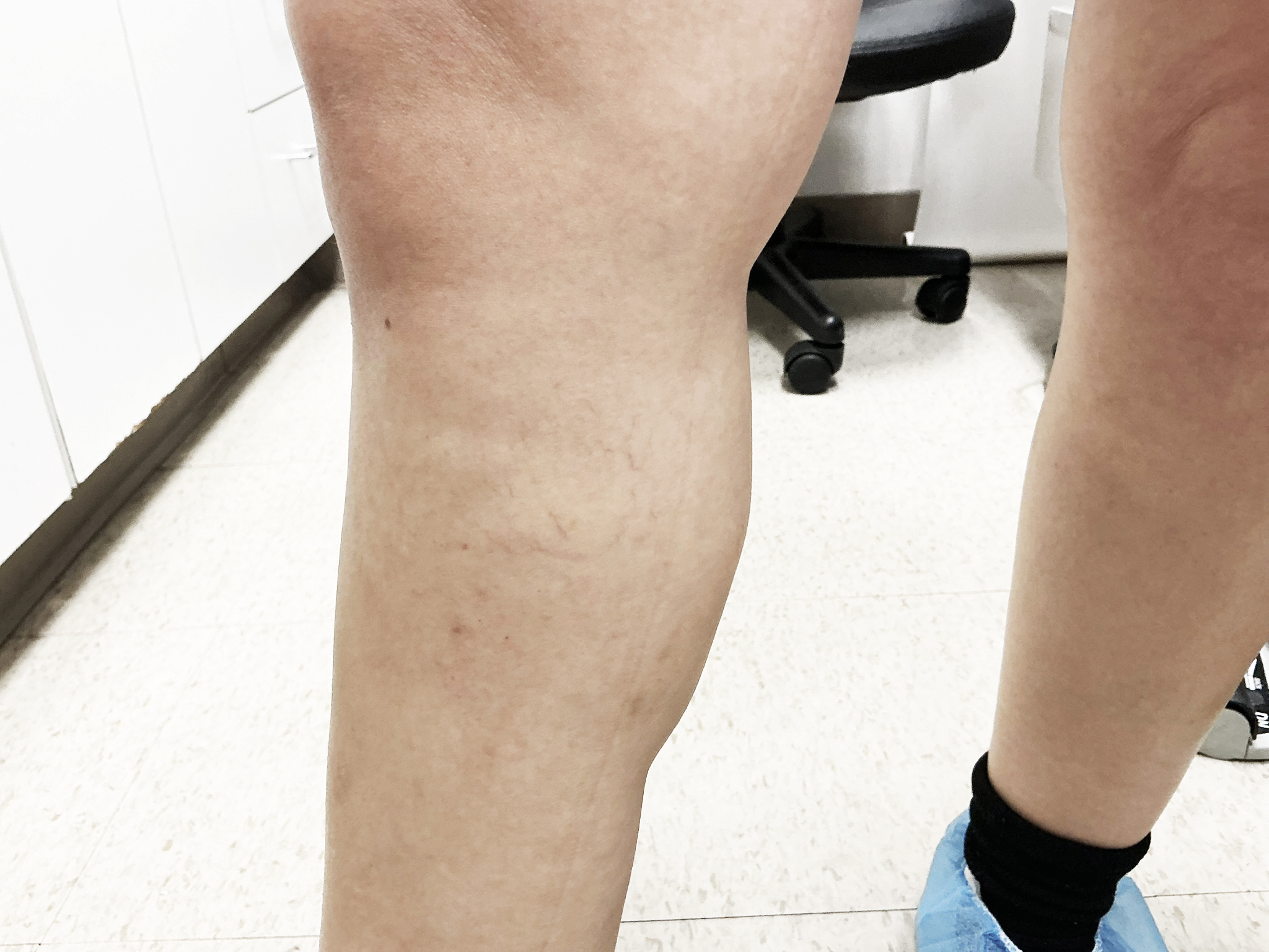 After Image: Sclerotherapy with phlebectomy - front