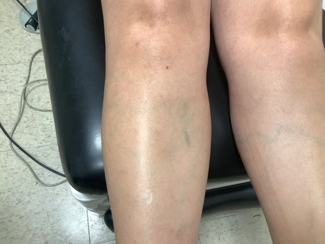 Before Image: Sclerotherapy with phlebectomy - front