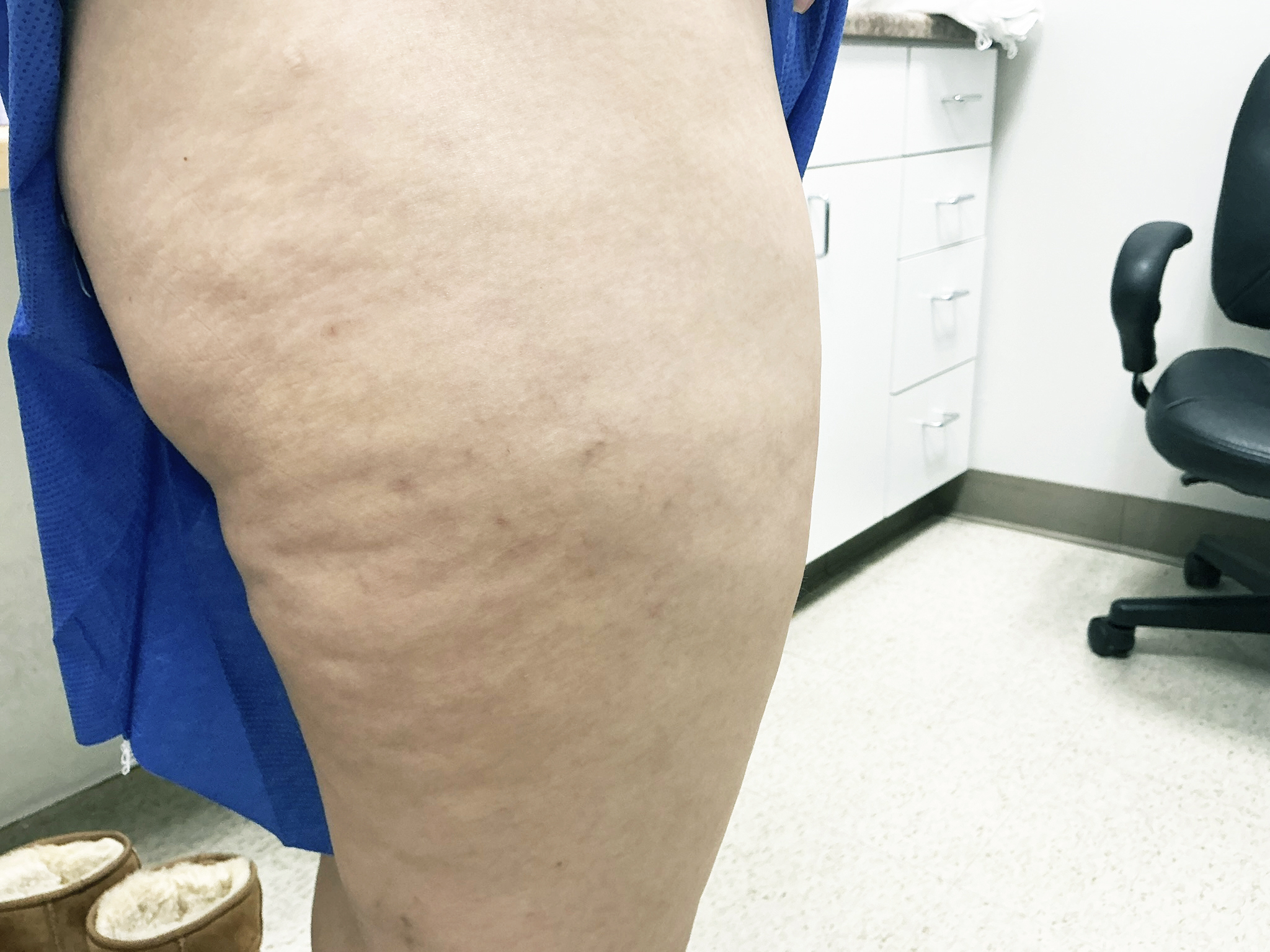 After Image: Visual sclerotherapy of spider veins - right-side