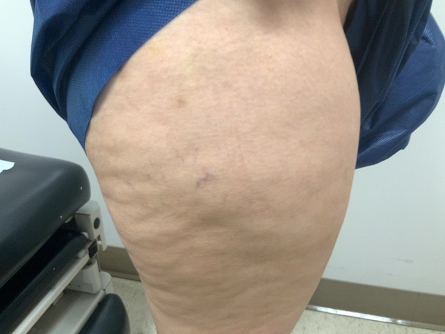Before Image: Visual sclerotherapy of spider veins - right-side