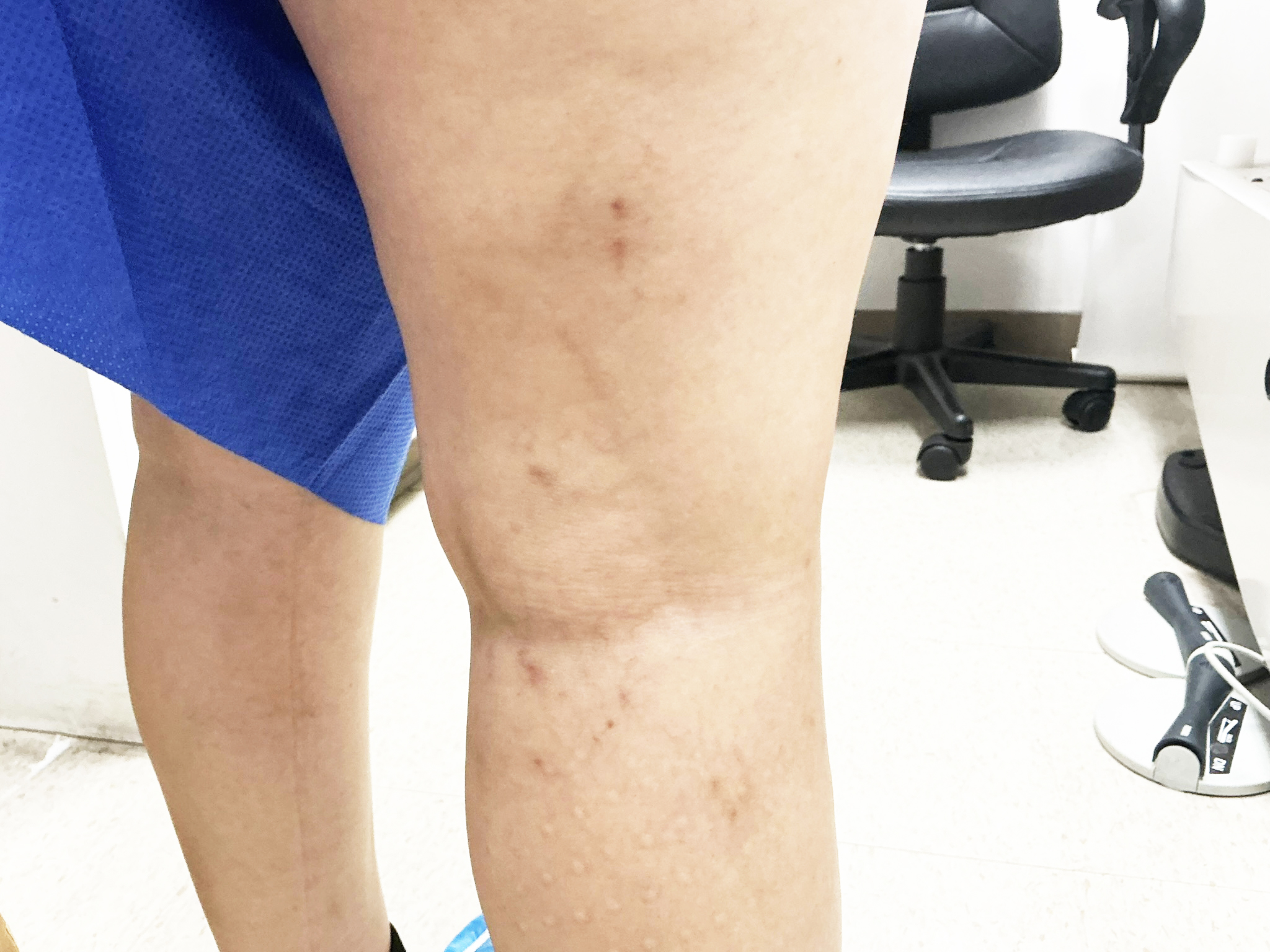 After Image: Sclerotherapy with microphlebectomy of posterior knee reticular veins - right-back-oblique