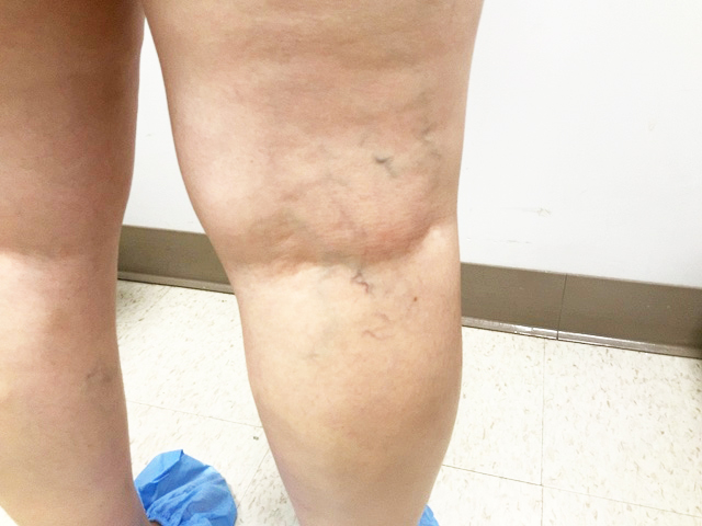 Before Image: Sclerotherapy with microphlebectomy of posterior knee reticular veins - right-back-oblique