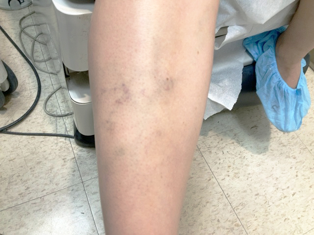 Before Image: Sclerotherapy with phlebectomy of varicose reticular veins - front