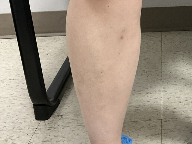 After Image: Sclerotherapy with phlebectomy of varicose reticular veins - front