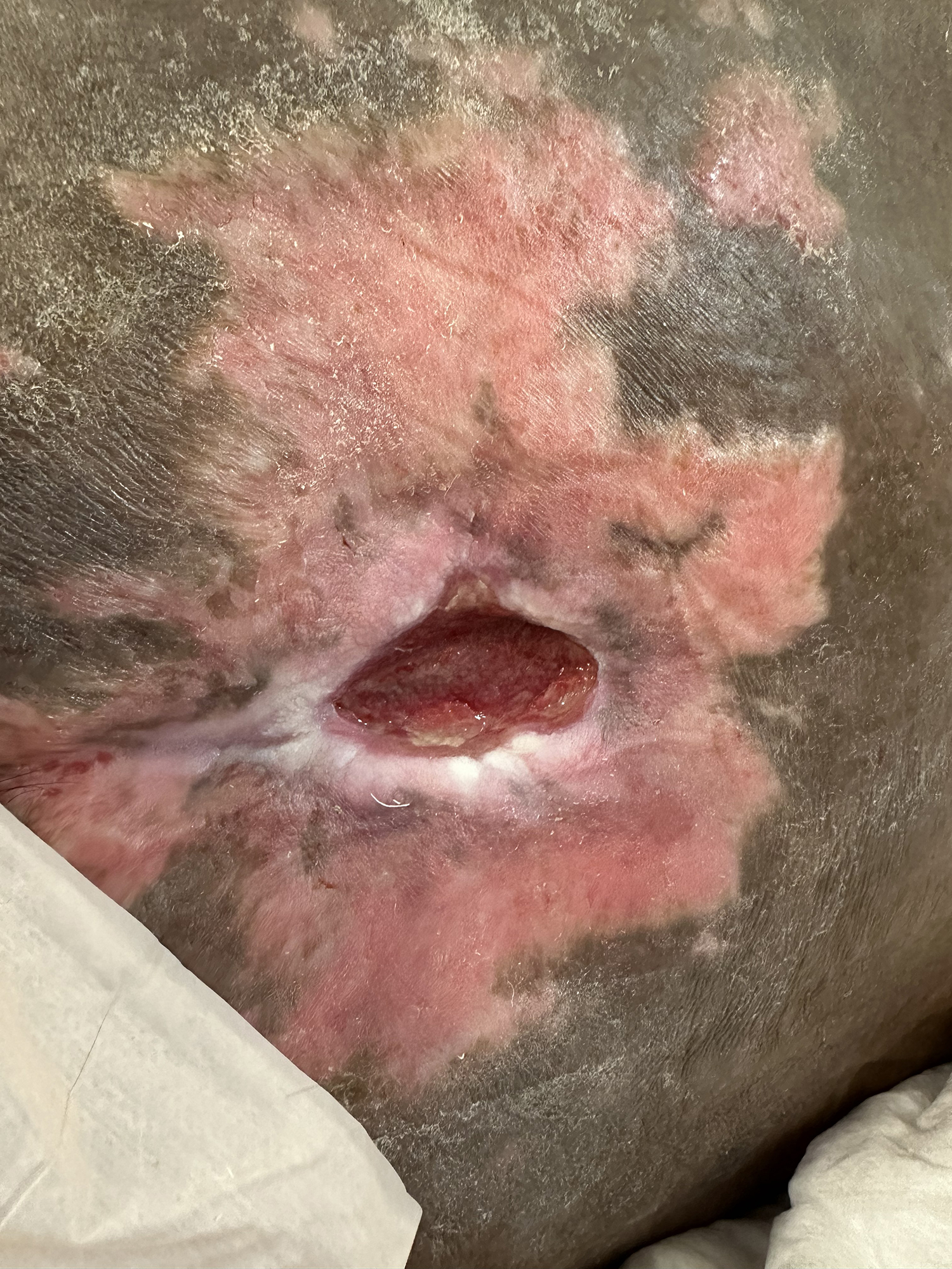 Before Image: Chronic Stage IV pressure ulcer on sacrococcyx - front