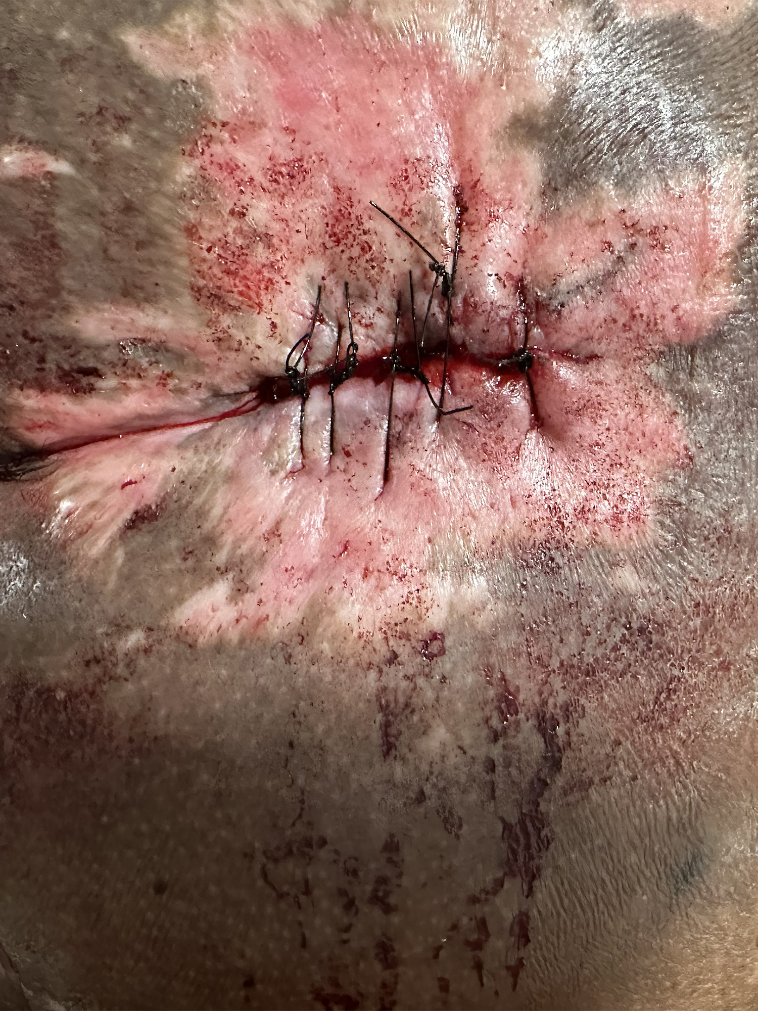 Before Image: Chronic Stage IV pressure ulcer on sacrococcyx - front