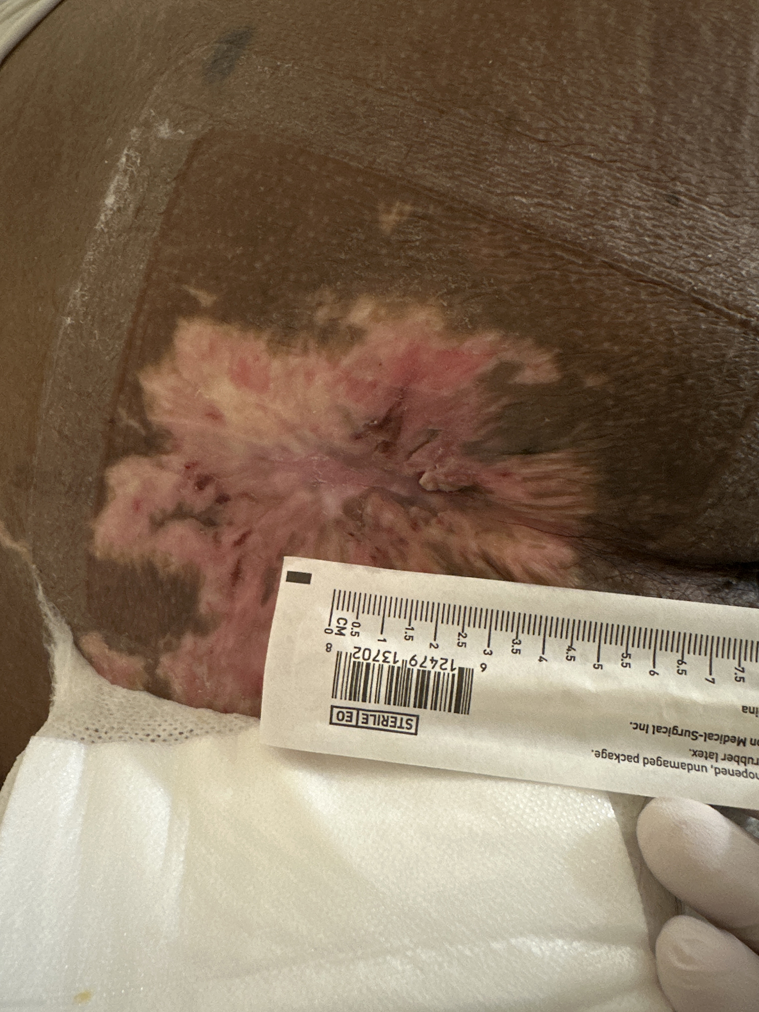 After Image: Chronic Stage IV pressure ulcer on sacrococcyx - front