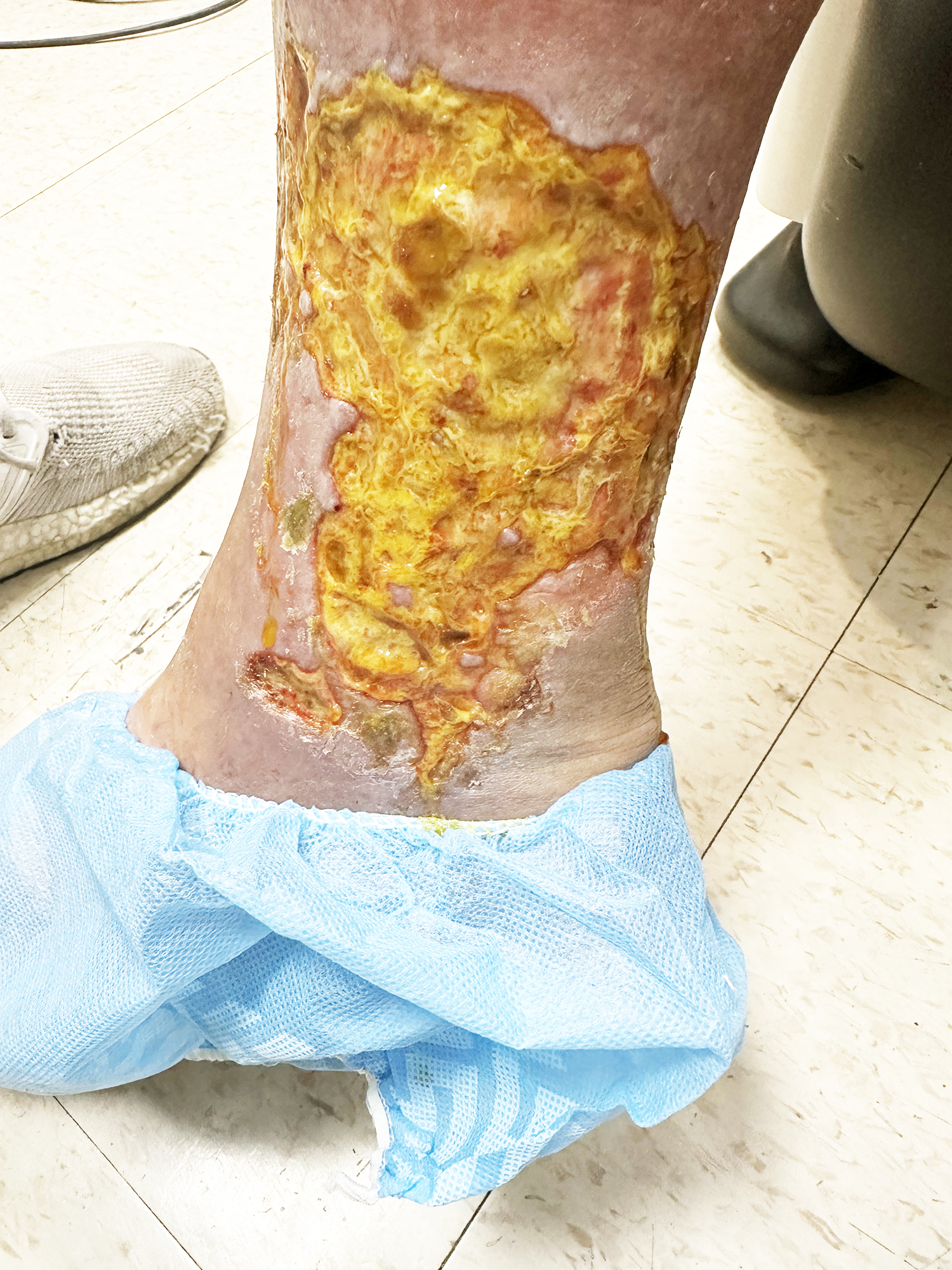 Before Image: Treatment of venous ulcer - front