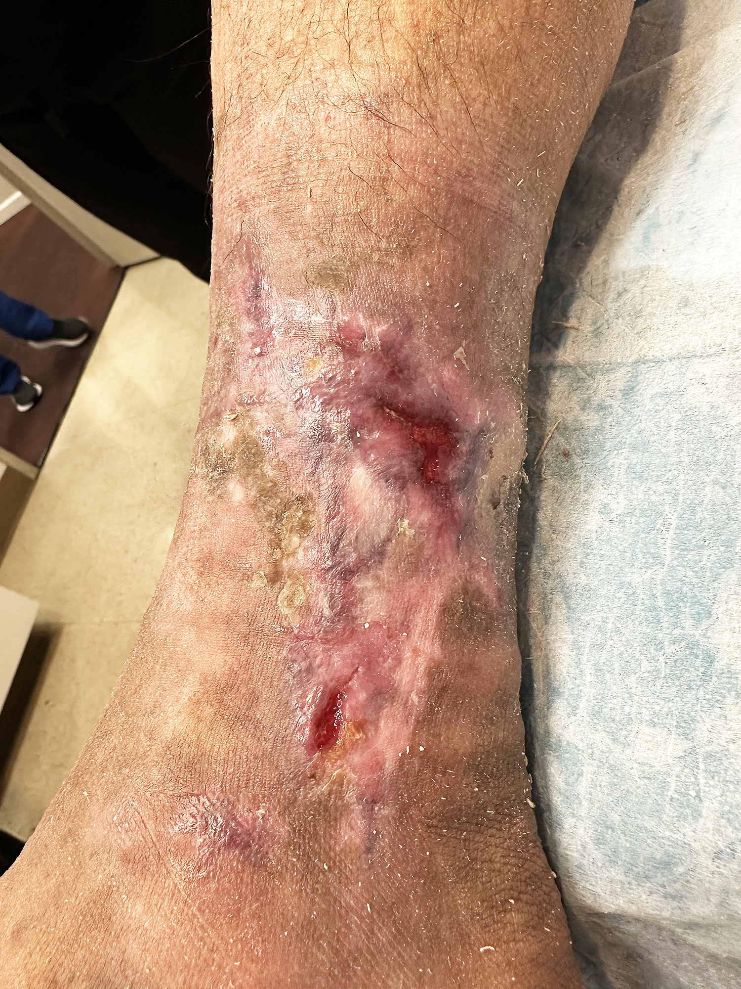 After Image: Treatment of venous ulcer - front