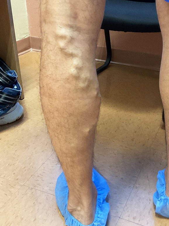 Before Image: Large posterior knee varicose vein - back