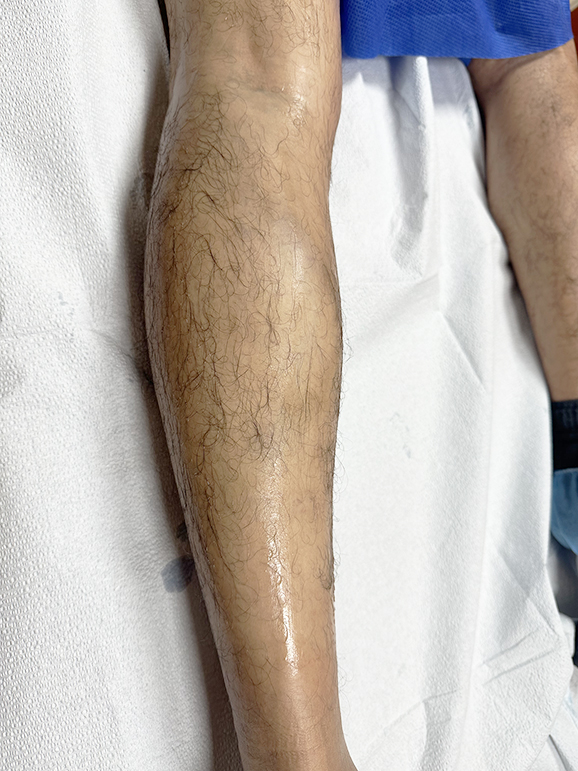 After Image: Large posterior knee varicose vein - back