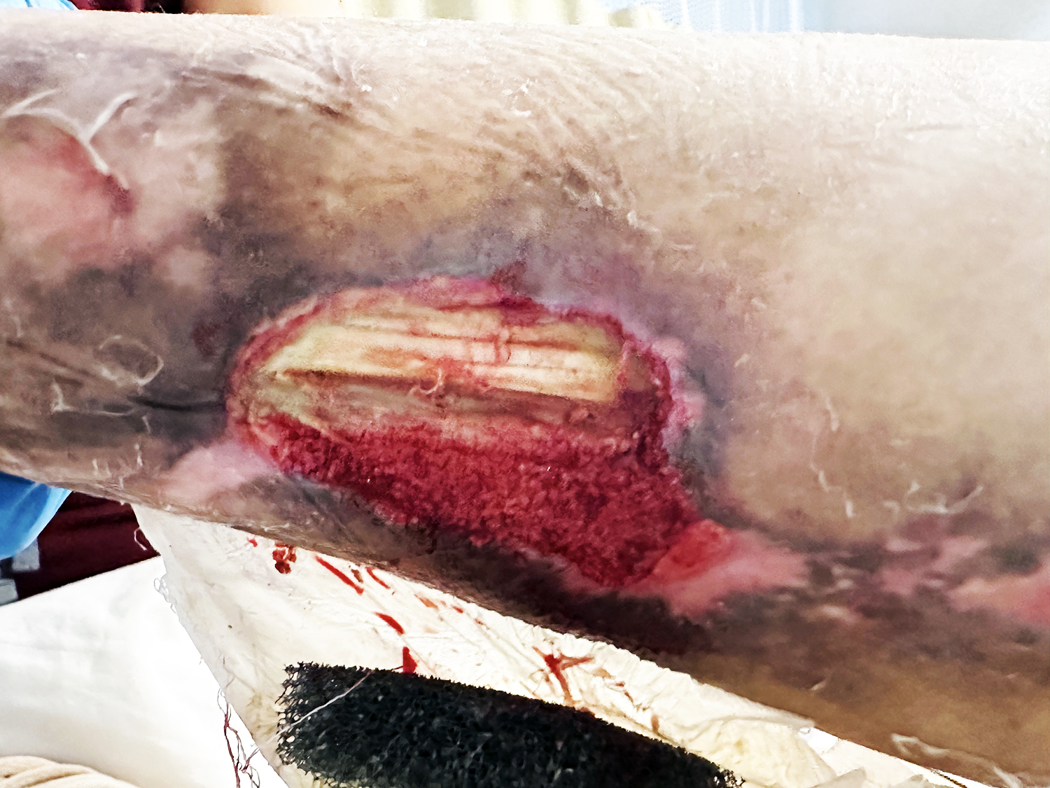 Before Image: Leg wound with tendon exposed - front
