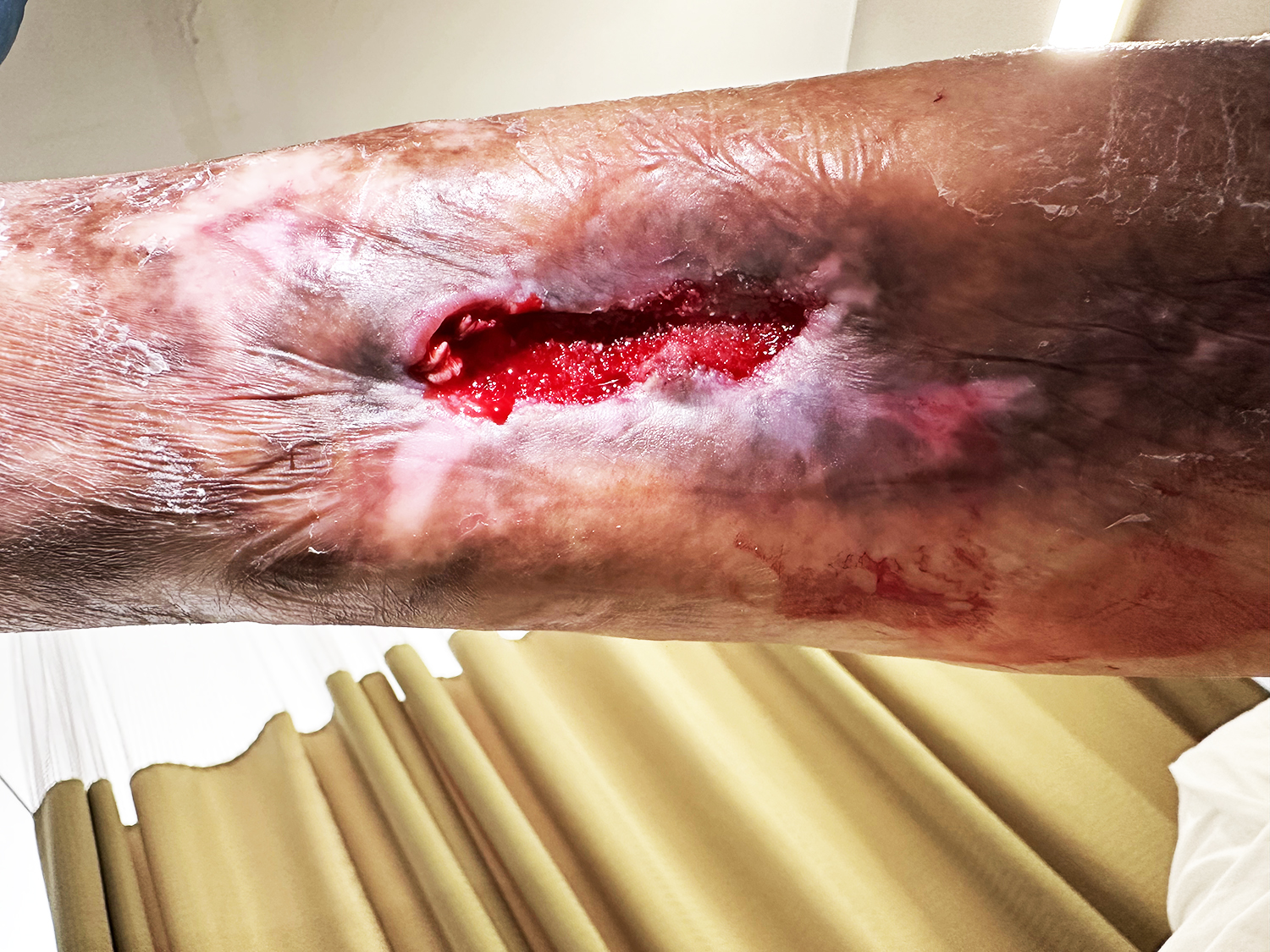 After Image: Leg wound with tendon exposed - front