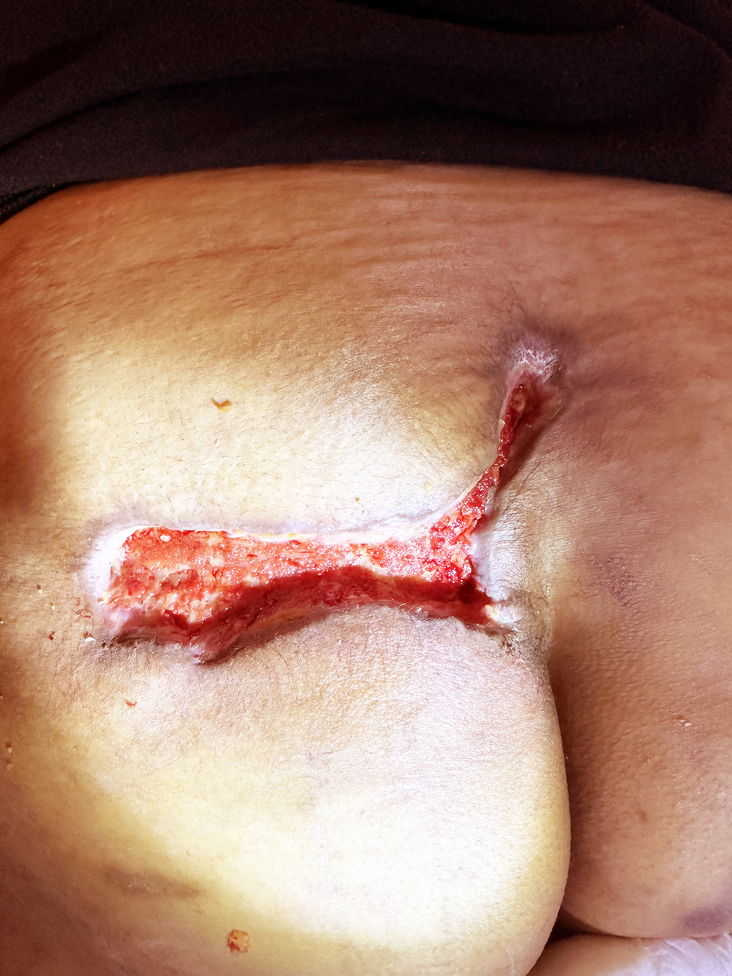 After Image: Large buttock wound - back