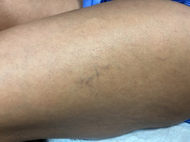 Before Image: Spider Veins and Reticular Veins - left-side