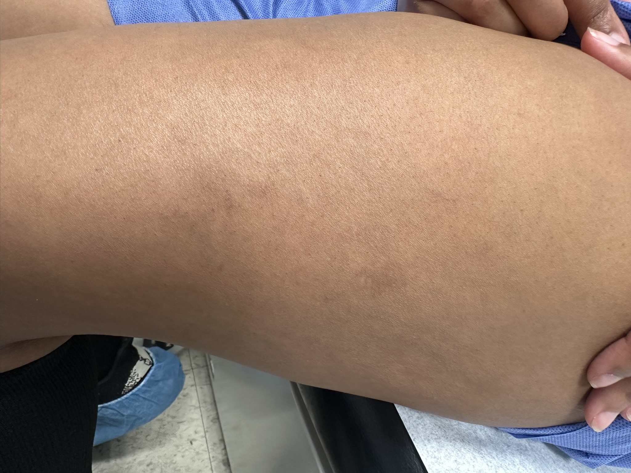 After Image: Spider Veins and Reticular Veins - left-side