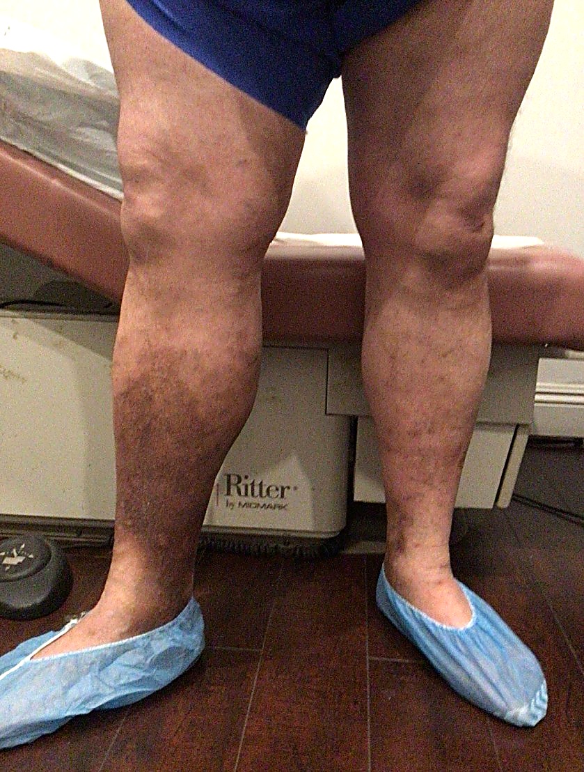 After Image: Chronic venous insufficiency of bilateral legs - front