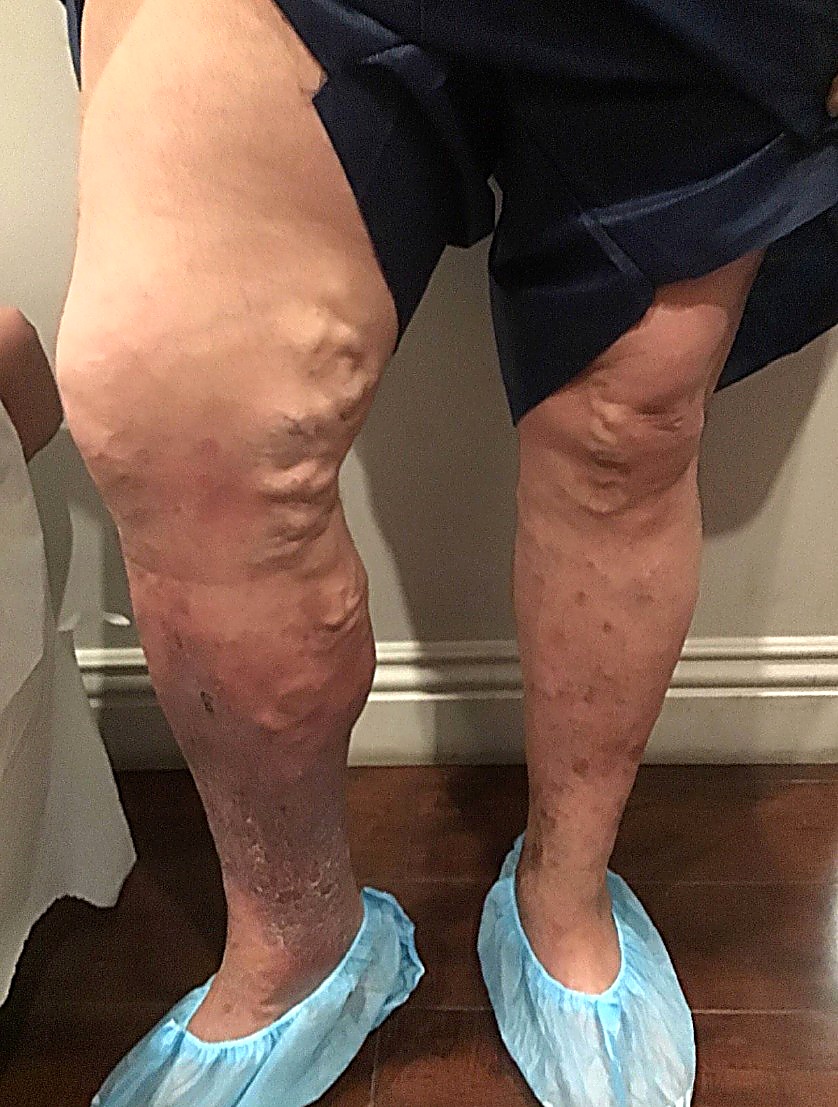 Before Image: Chronic venous insufficiency of bilateral legs - front