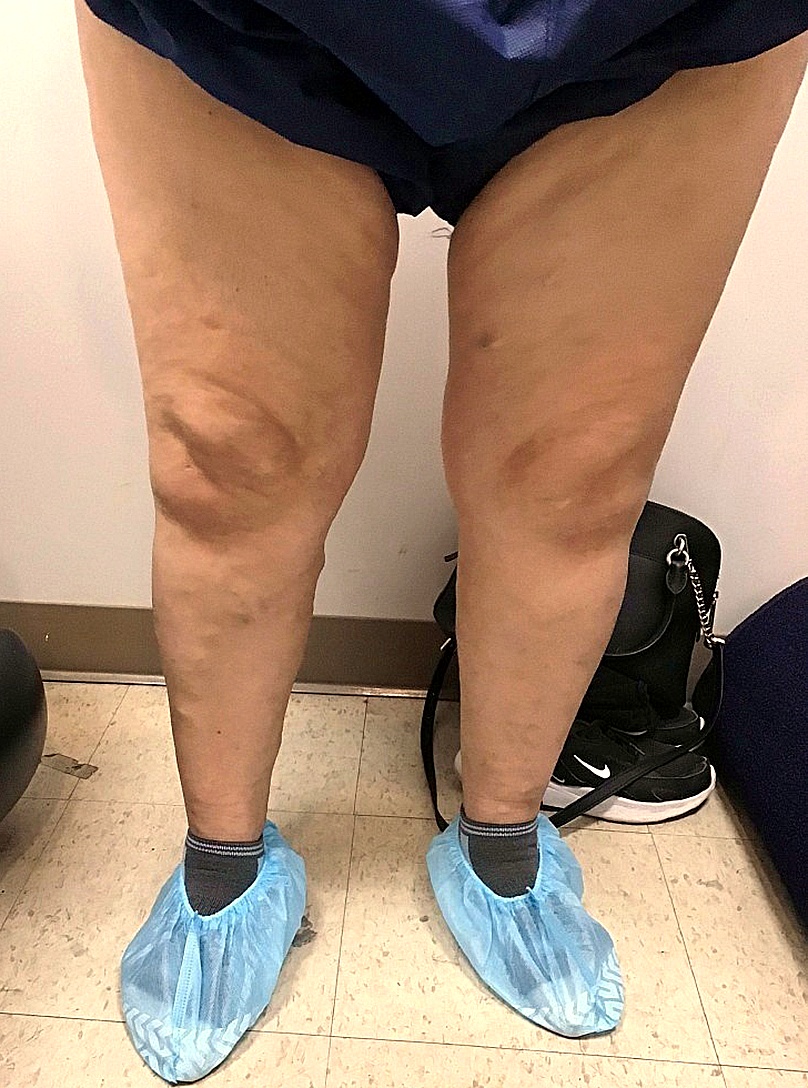 Before Image: Treatment of varicose veins - front
