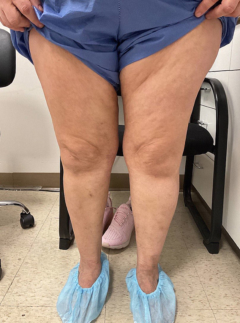 After Image: Treatment of varicose veins - front