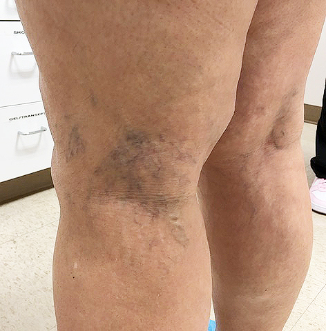 Before Image: Sclerotherapy with microphlebectomies of large reticular/spider vein cluster - back