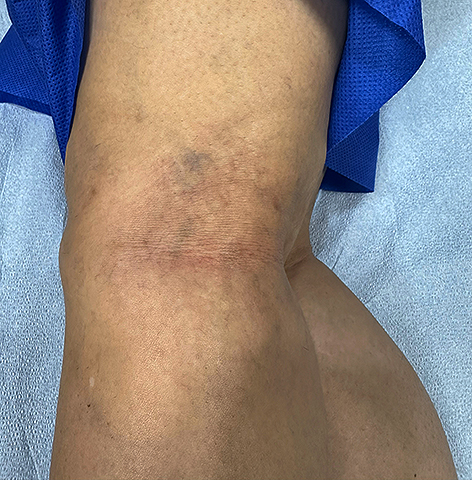 After Image: Sclerotherapy with microphlebectomies of large reticular/spider vein cluster - back
